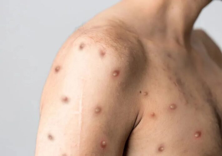 Brasil registra primeiro caso da nova variante de mpox em São Paulo 3 Brasil registra primeiro caso da nova variante de mpox em São Paulo