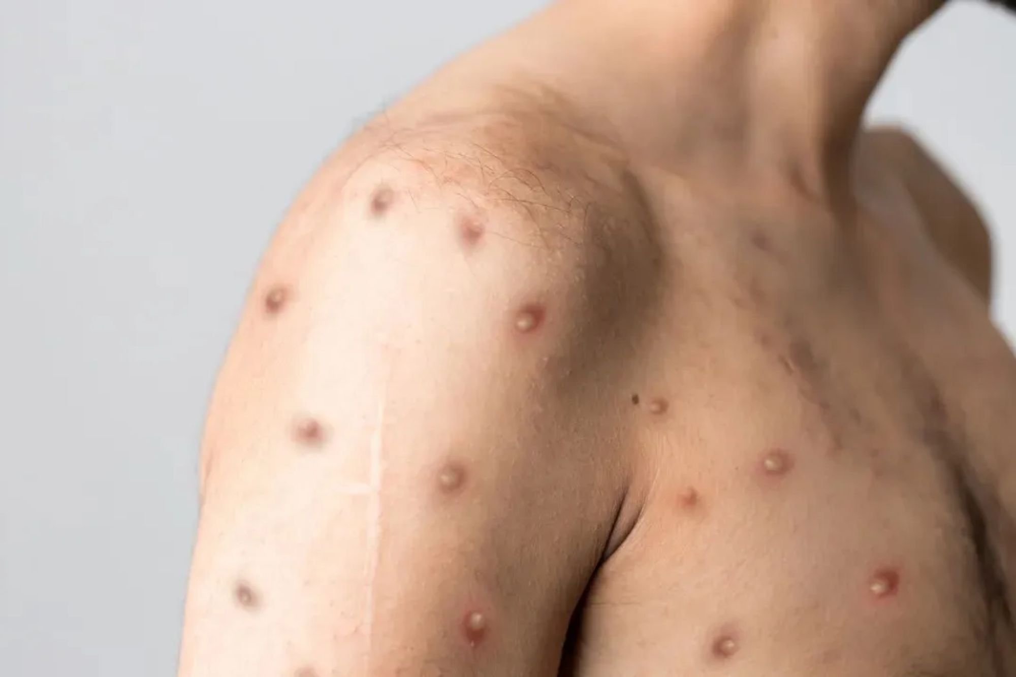 Brasil registra primeiro caso da nova variante de mpox em São Paulo 2 Brasil registra primeiro caso da nova variante de mpox em São Paulo